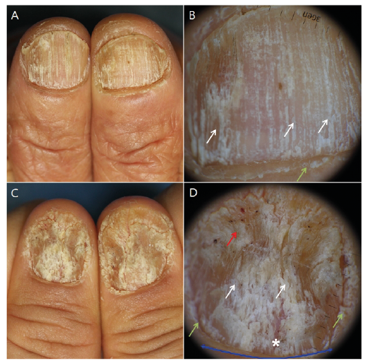 Dermoscopic Evaluation of Inflammatory Nail Disorders and Their Mimics |  HTML | Acta Dermato-Venereologica