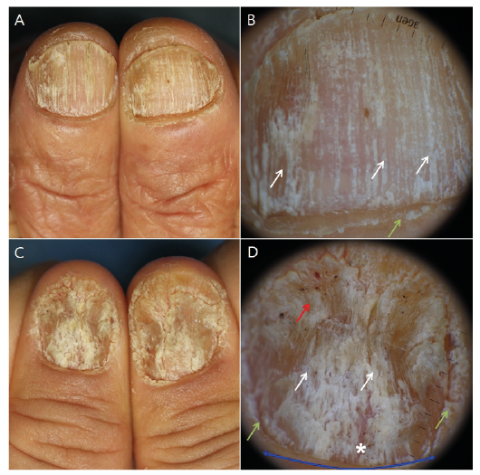 Structure of Nails And Nail Disorders