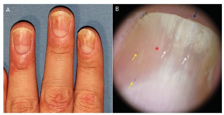 Dermoscopic Evaluation of Inflammatory Nail Disorders and Their Mimics |  HTML | Acta Dermato-Venereologica