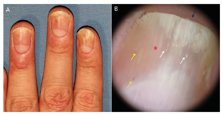 What do vertical lines on fingernails indicate? - Quora