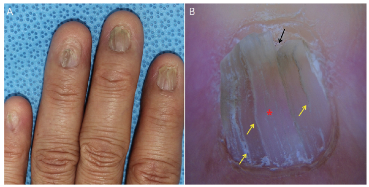 Transverse, brown-greyish hyperpigmentation on the proximal half of the...  | Download Scientific Diagram