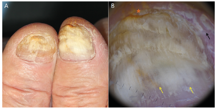 Methyl Ethyl Ketone-Related Loss of Matrix With Nail Onycholysis and  Pterygium (ME KLMNOP): Case Report of a New Etiology for On