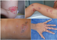 Skin Infections Caused by Staphylococcus aureus, HTML