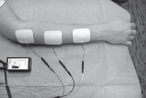 Journal of Rehabilitation Medicine - Non-invasive neuromuscular electrical  stimulation in patients with central nervous system lesions: An educational  review - HTML