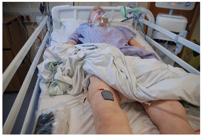 Frontiers  Safety and efficacy of electrical stimulation for  lower-extremity muscle weakness in intensive care unit 2019 Novel  Coronavirus patients: A phase I double-blinded randomized controlled trial