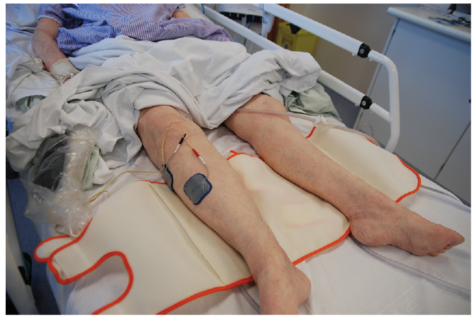 Effect of neuromuscular electrical stimulation combined with early  rehabilitation therapy on mechanically ventilated patients: a prospective  randomized controlled study, BMC Pulmonary Medicine